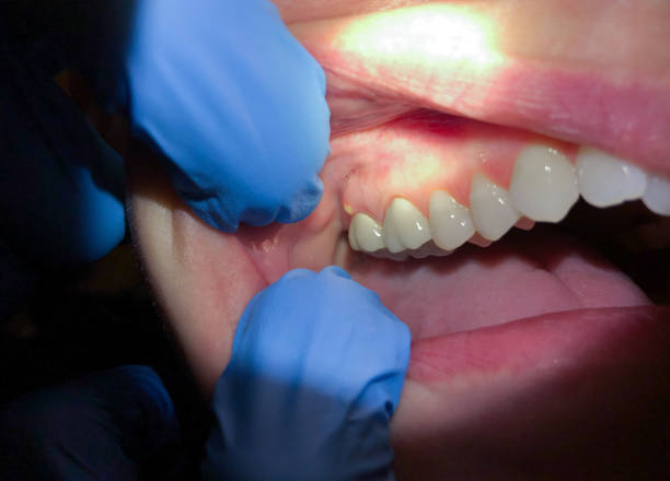 Best Emergency Wisdom Teeth Removal in New Albany, OH