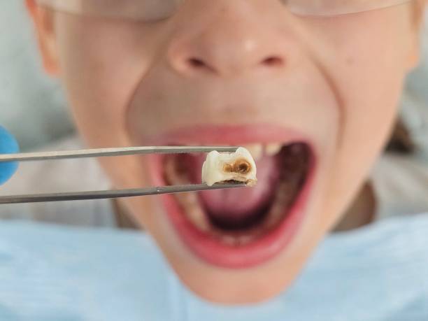 Best Emergency Tooth Extraction in New Albany, OH